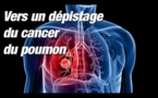 Cancer du poumon : une vaste étude contredit la HAS sur l’intérêt d’un dépistage systématique