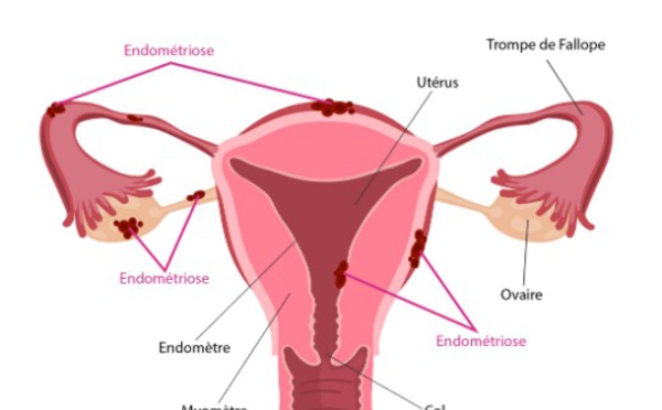 Endométriose : attention tabou !