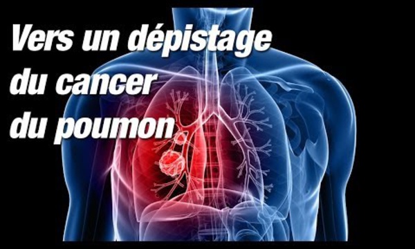 Cancer du poumon : une vaste étude contredit la HAS sur l’intérêt d’un dépistage systématique